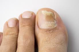 simptome și tratamentul ciupercii unghiilor de la picioare)
